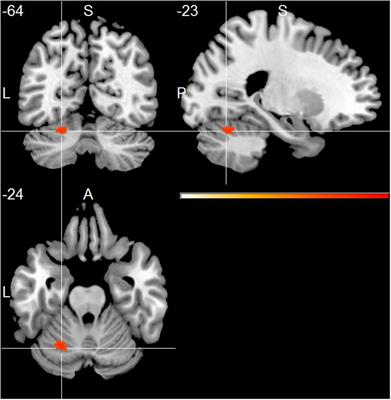 Early Changes in Alpha Band Power and DMN BOLD Activity in Alzheimer’s Disease: A Simultaneous Resting State EEG-fMRI Study